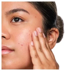 Salicylic Acid 2% Solution